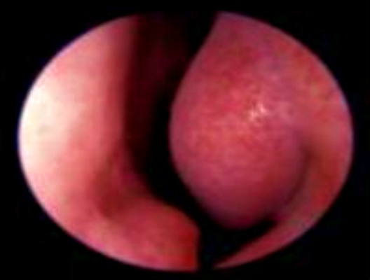 muqueuse nasale saine